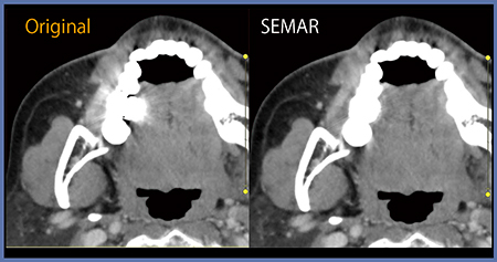 図5　SEMARを用いたメタルアーチファクト低減（適用前後の比較）