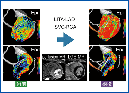 図6　症例2のCCTA＋Dynamic Perfusion解析による術前・術後の比較1）