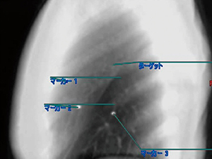 図2　4Dモーション解析を用いた金マーカの指定、距離計測