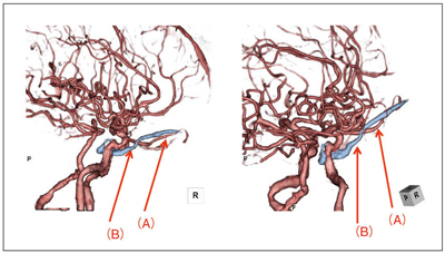 図4　海綿静脈洞動静脈瘻のサブトラクション
