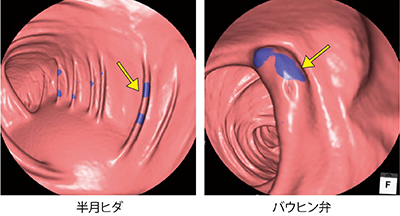 図2　PhyZio Enhanceフィルター機能の偽陽性例　隆起した正常構造物が着色されている。