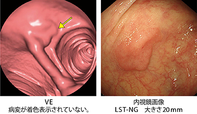 図3　PhyZio Enhanceフィルター機能の偽陰性例