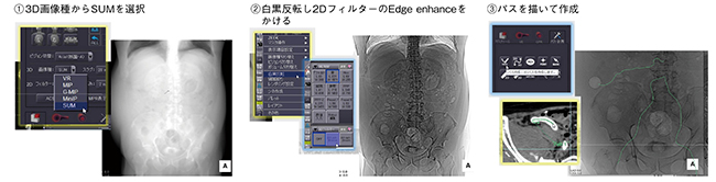 図5　Ziostation2による仮想透視画像作成手順