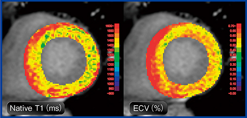 図1　MR心筋T1マッピングによる心筋評価：心アミロイドーシス