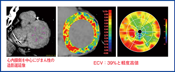 図2　症例2のCT-ECV解析