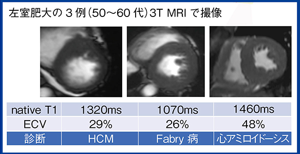 図5　シナリオ5　左室肥大の3例