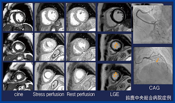 図1　‌50歳代，女性，胸部不快感症例の心臓MRI