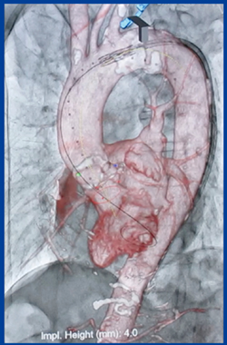 図2　Ziostation2によるTAVI治療支援