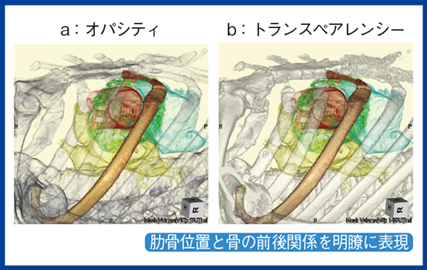 図3　トランスペアレンシーで作成したMICS AVR術前画像