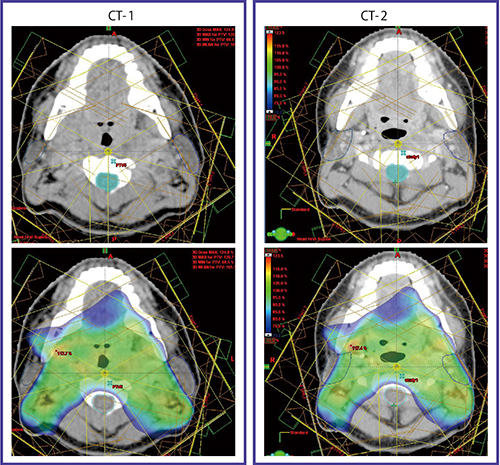 図3　治療開始前CT-1と38Gy時点のCT-2