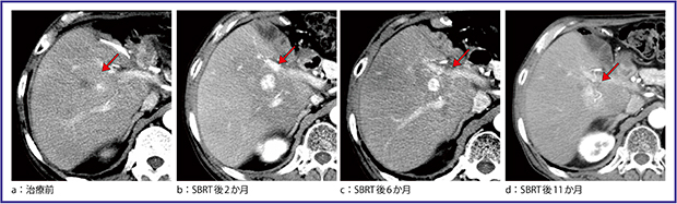 図2　SBRT後に早期濃染が遷延した一例