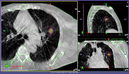 図3　CBCTによる腫瘍の三次元位置照合