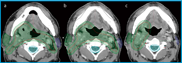 図3　SmartAdaptを用いたブーストプランへのコンツールの貼り付け aはイニシャルプランコンツール，bはブーストプラン用CTへのイニシャルプランコンツールの貼り付け，cはSmartAdaptを用いたコンツールの貼り付け。臨床標的体積（CTV），PTVは再コンツール。