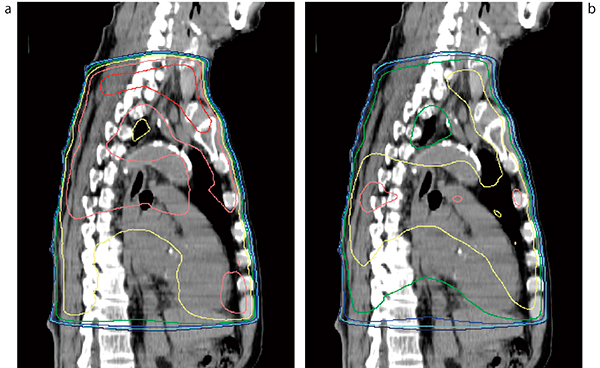 図5　FFFによる進行食道がんの対向2門照射の平坦度改善 a：10MVX線前後対向2門照射では，ピーク線量は照射野中心の114.7％に達する。 b：10MVFFFX線を20％混合することで，ピーク線量は106.8％に低下した。