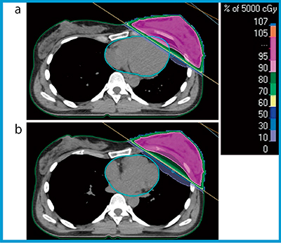 図1　全乳房照射における自由呼吸時（a）と深吸気息止め時（b）の線量分布の比較
