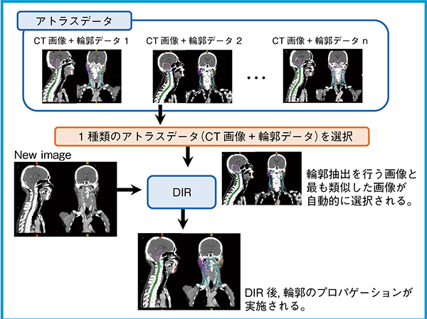 図1　シングルアトラス法の概念図