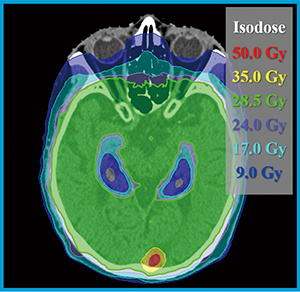 図3　HyperArcを用いて計画された局所同時ブースト併用海馬抜き全脳照射の線量分布