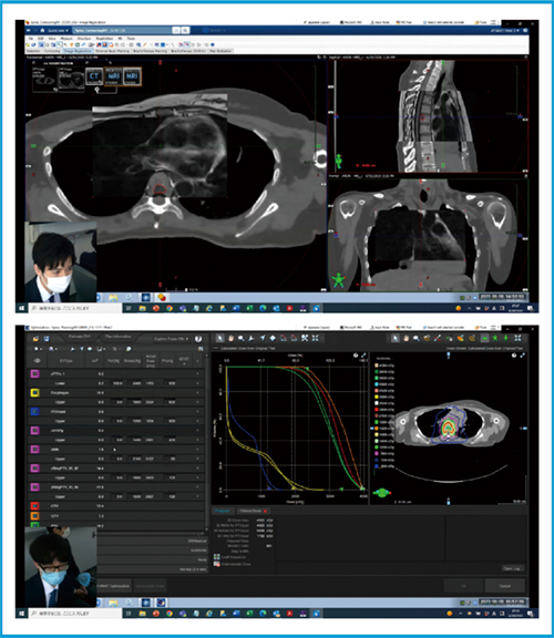 図3　「Varian SBRT PRACTICE for Spine Metastasis」でのCT-MRフュージョンと線量分布最適化の画面