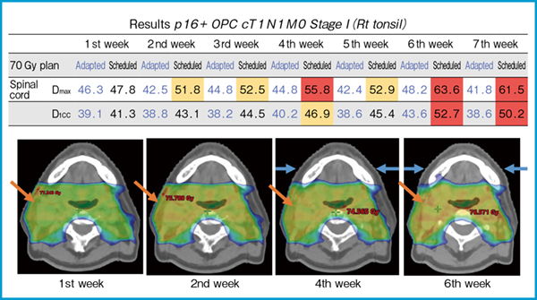 図2　治療期間中に腫瘍縮小および痩せを認めた症例の脊髄線量と線量分布