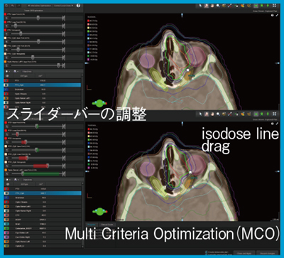 図2　MCOスライダーバー調整とisodose line drag