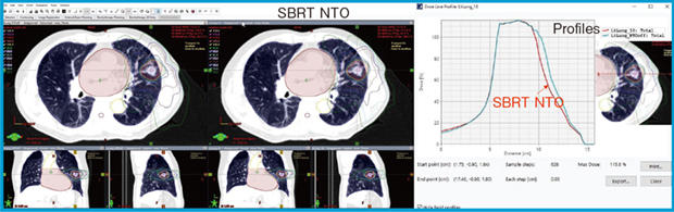 図3　SBRT NTOを用いた線量分布（肺がん）