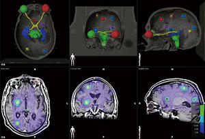 図1　Brain Metsにおける線量分布の表示