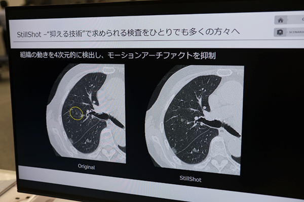 「Body StillShot」などの機能により高精度の画像診断を実現